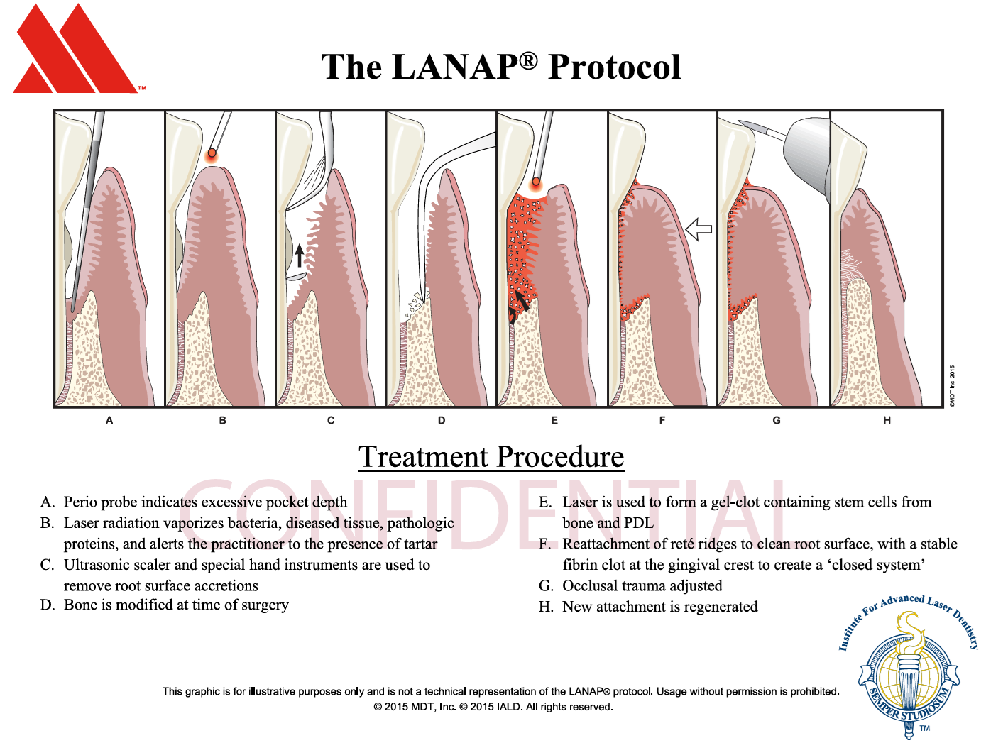 Graphic of how the LANAP process works