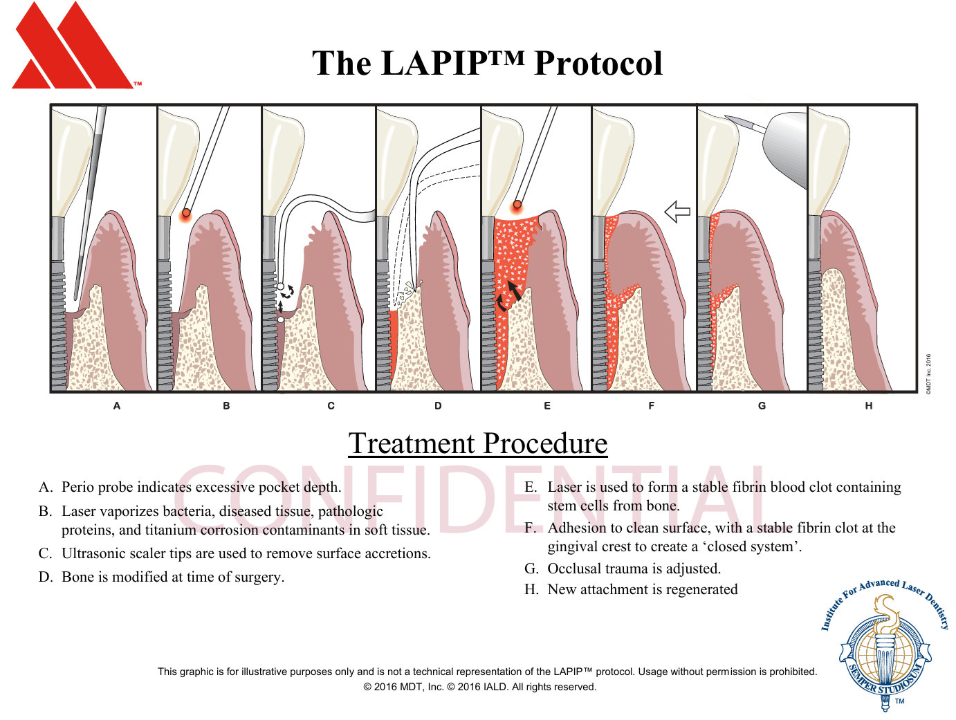 Graphic of how the LAPIP process works