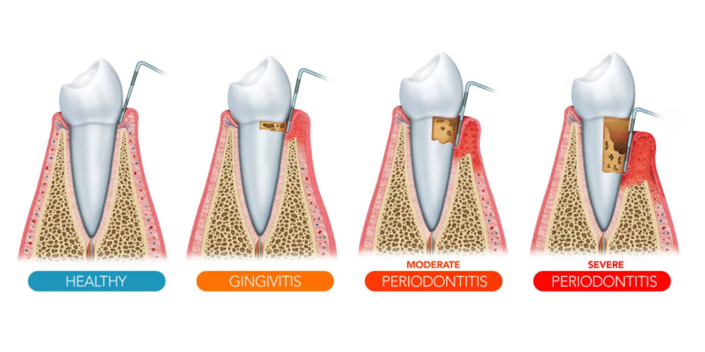 Image of various gum and tooth conditions